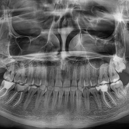 Ортопантомограмма, панорамный снимок зубов кариес
