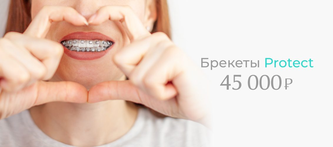 Безлигатурная брекет-система Protect на обе челюсти всего за 45 000 рублей!