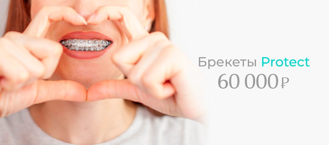 Безлигатурная брекет-система Protect на обе челюсти всего за 60 000 рублей!